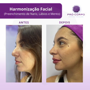 Harmonização Facial